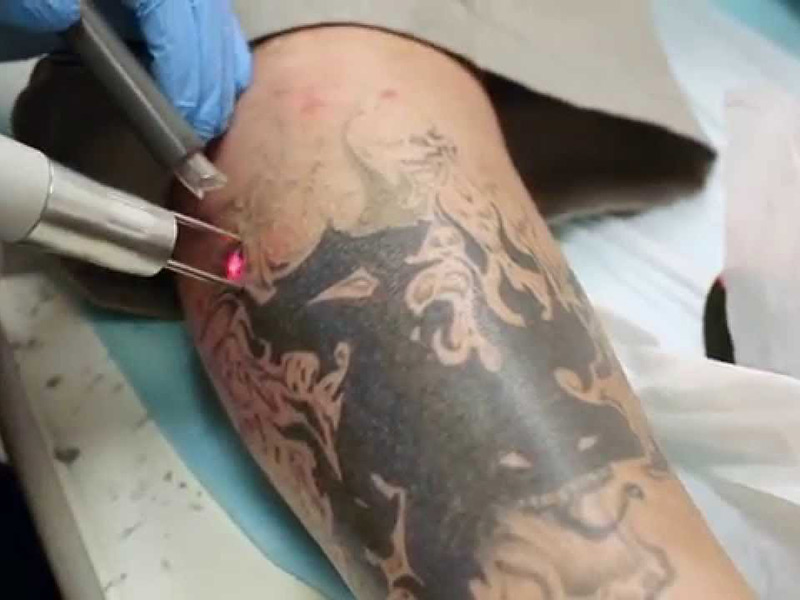 remover-tatuaje.jpg